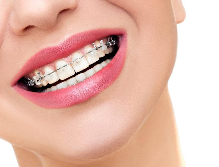 5-smart-money-tips-for-how-to-pay-for-braces