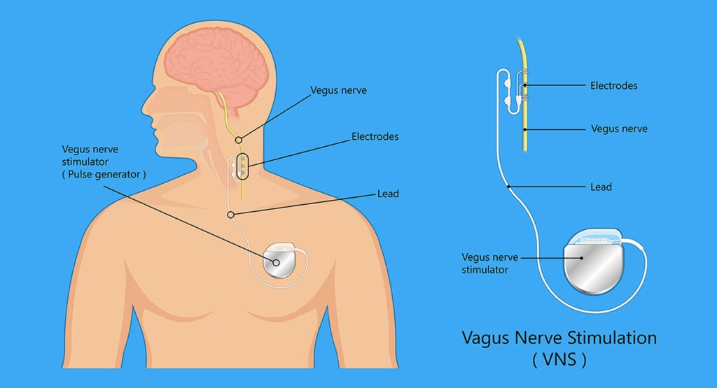 What Is Vivistim: The Future of Stroke Treatment - Insurdinary